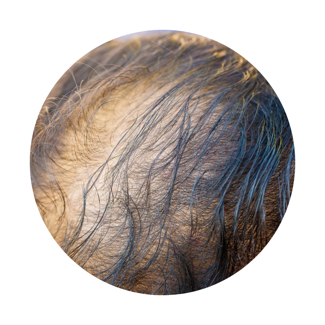 Non-Surgical Hair Restoration